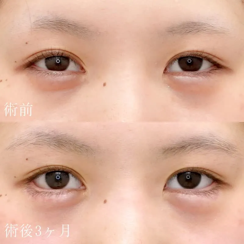 たれ目形成(グラマラスライン形成)の症例写真③