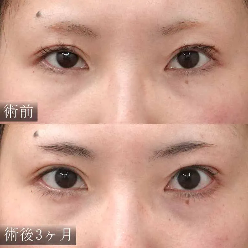 たれ目形成（グラマラスライン形成）の症例写真③
