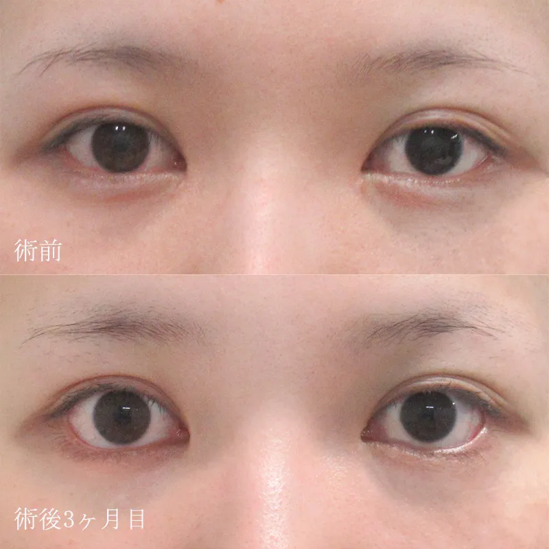 たれ目形成（グラマラスライン形成）の症例写真③