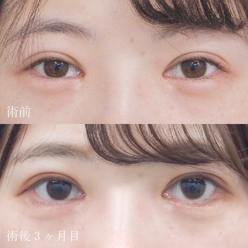 たれ目形成（グラマラスライン形成）の症例写真①