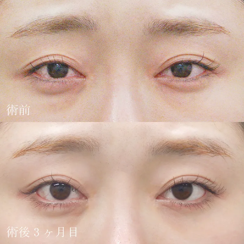 たれ目形成（グラマラスライン形成）の症例写真①