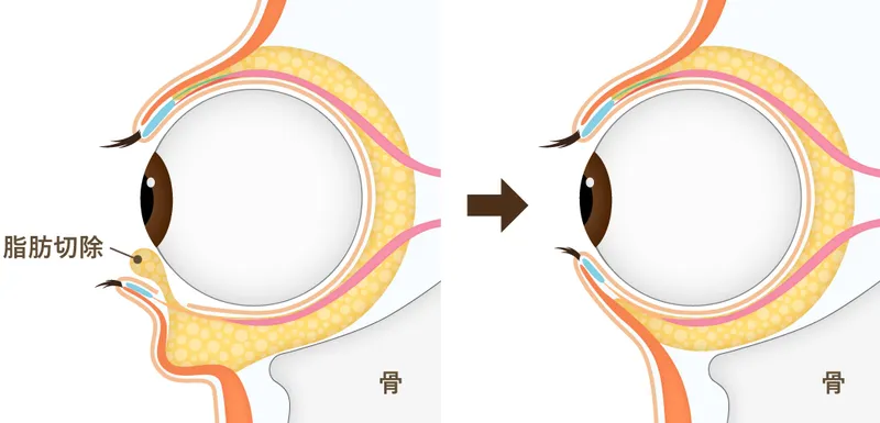 目の下の脂肪取り（下眼瞼脱脂）
