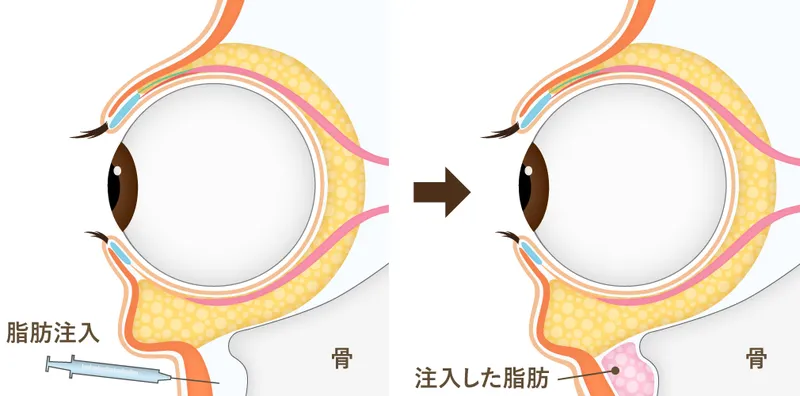 脂肪注入