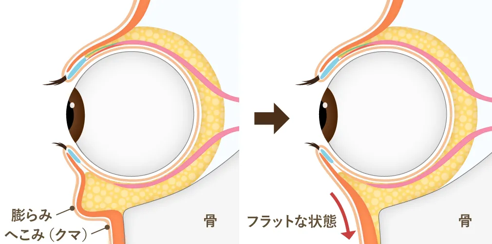 ハムラ法（目の下のたるみ取り）の施術方法