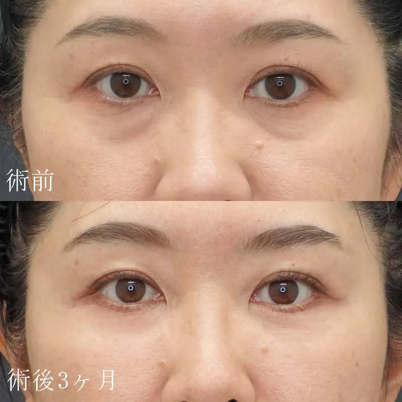 目の下のたるみ取り（ハムラ法）の症例写真