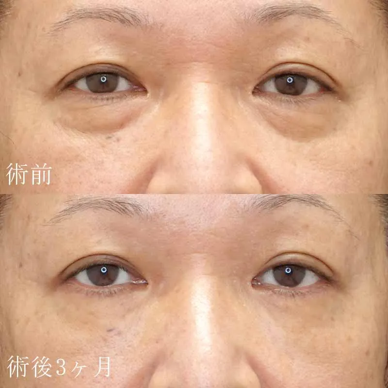 目の下のたるみ取り（ハムラ法）の症例写真