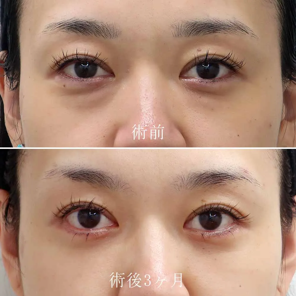 目の下のたるみ取り（ハムラ法）の症例写真