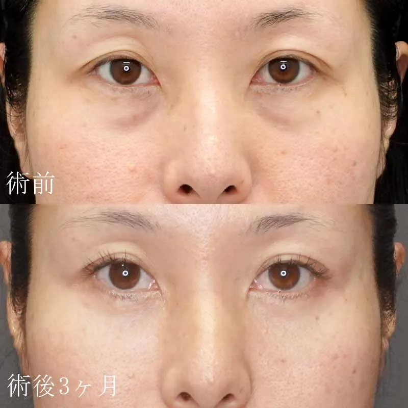 目の下のたるみ取り（ハムラ法）の症例写真
