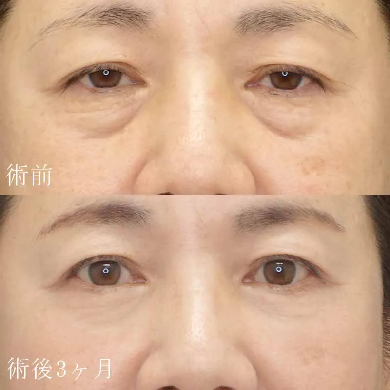 目の下のたるみ取り（ハムラ法）の症例写真