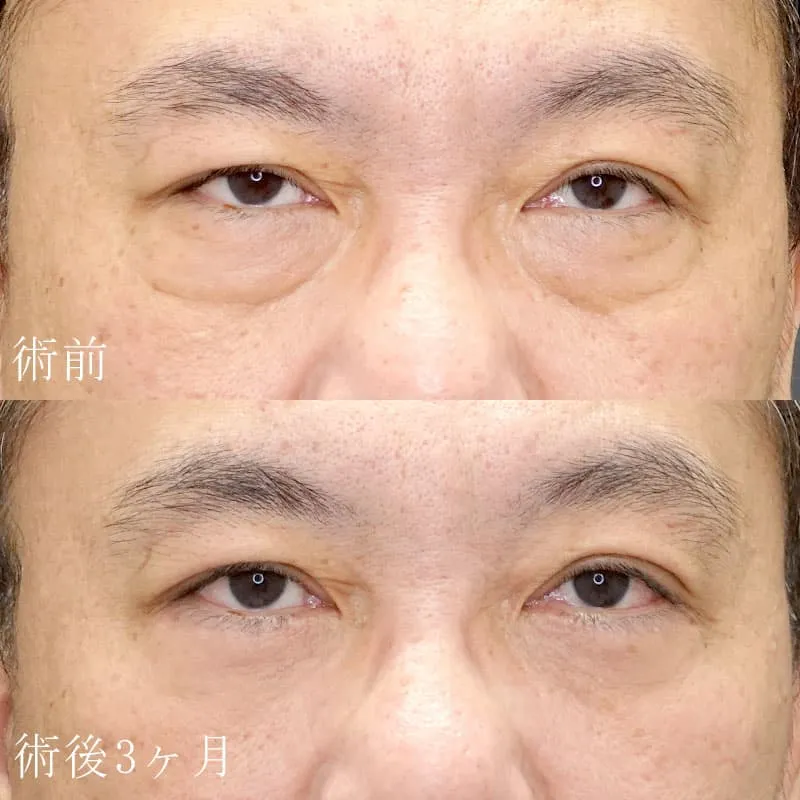 目の下のたるみ取り（ハムラ法）の症例写真