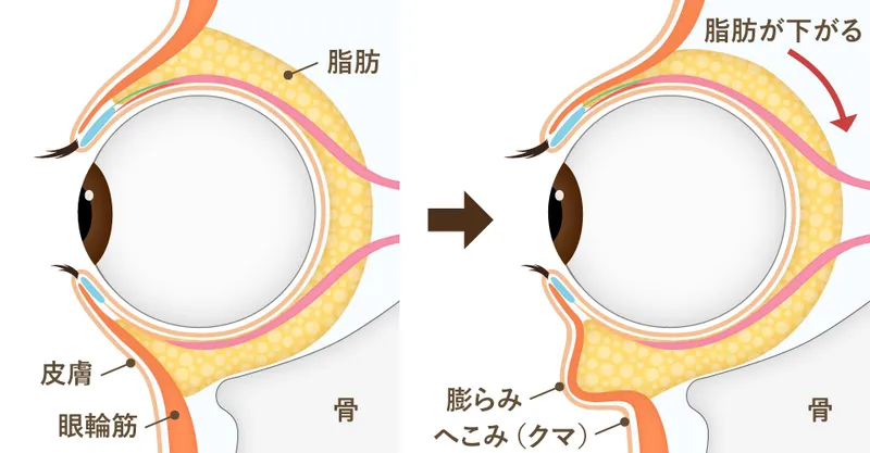 目の下のたるみの原因