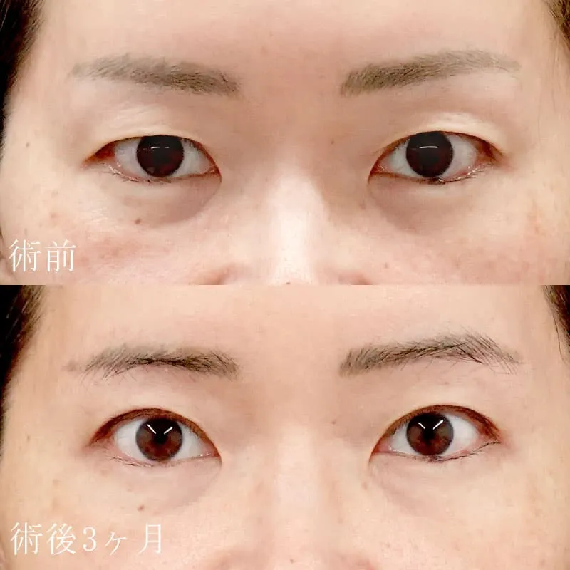 眉下切開の症例写真
