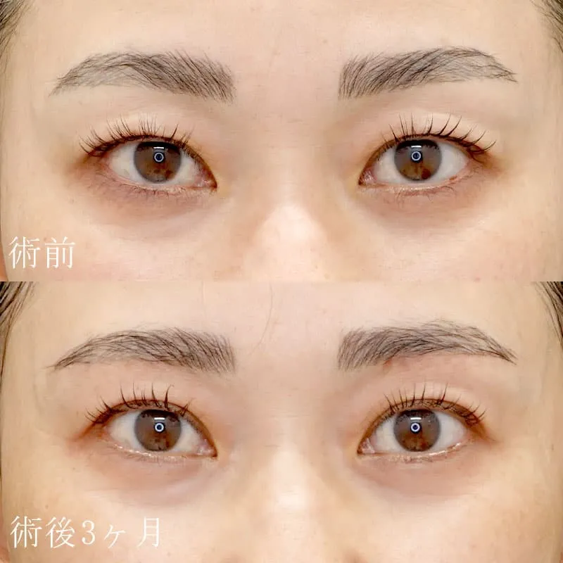 眉下切開の症例写真