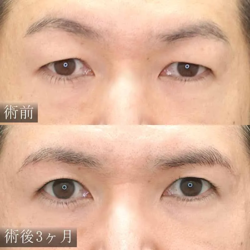 眉下切開の症例写真