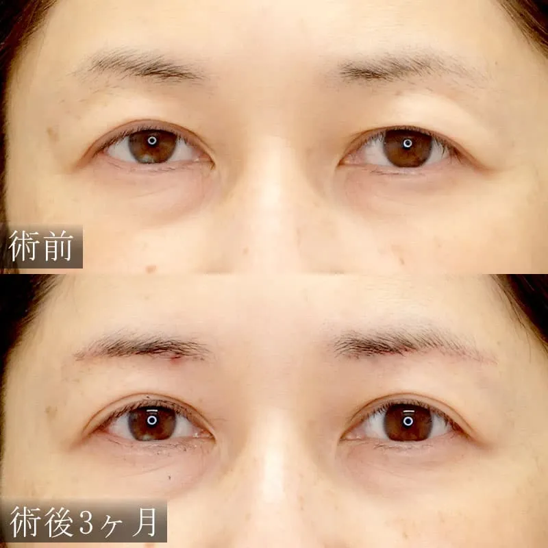 眉下切開の症例写真