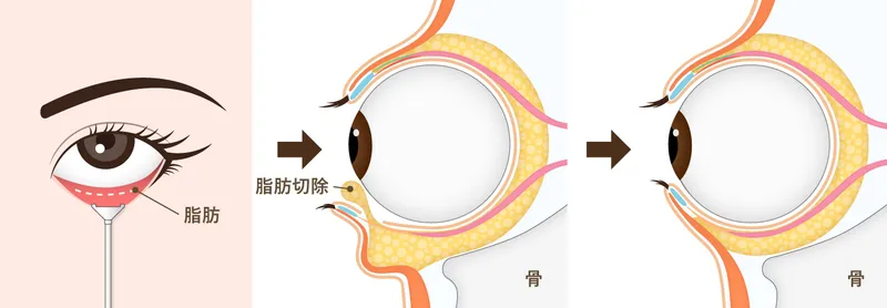 下まぶたの脂肪取り