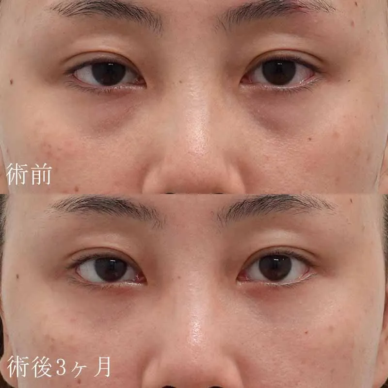 裏ハムラ法の症例写真