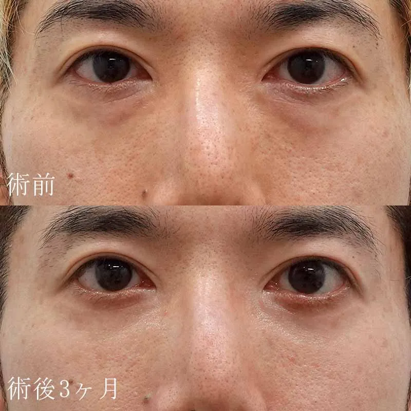 裏ハムラ法の症例写真