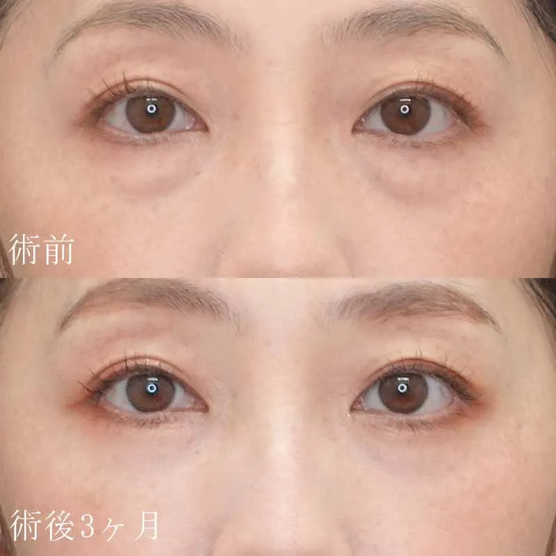 裏ハムラ法の症例写真