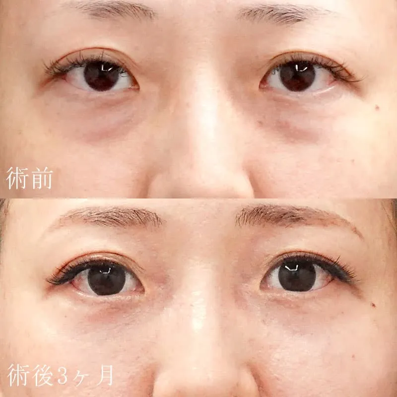 裏ハムラ法の症例写真