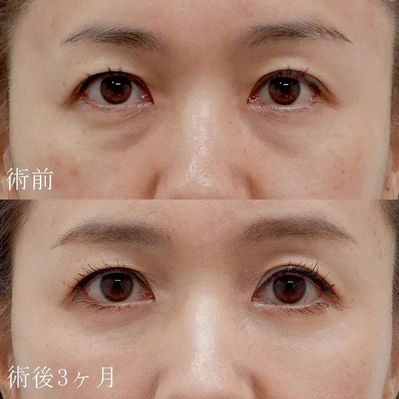 裏ハムラ法の症例写真