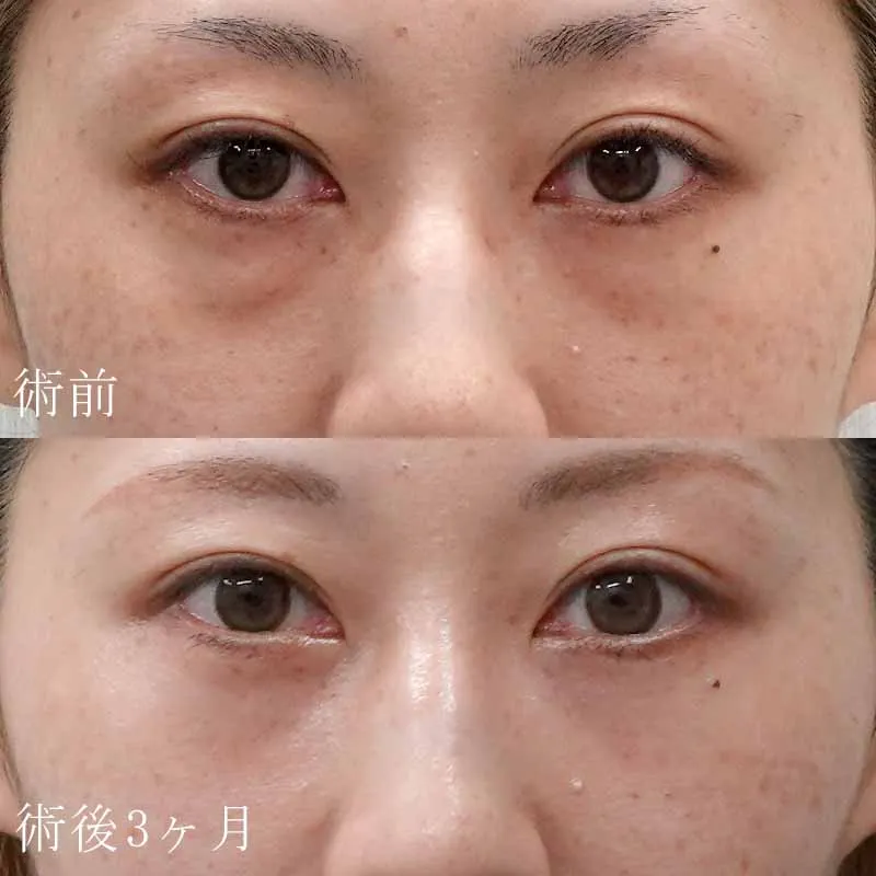 裏ハムラ法の症例写真
