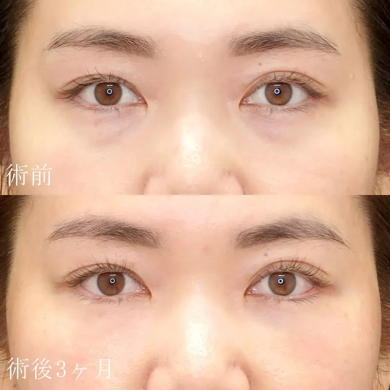 裏ハムラ法の症例写真