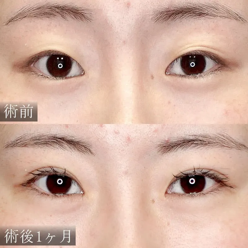 奥二重から二重にしたい