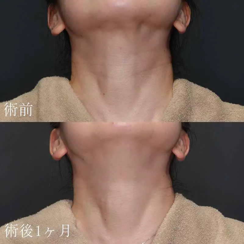 バイオスカルプチャーの症例写真