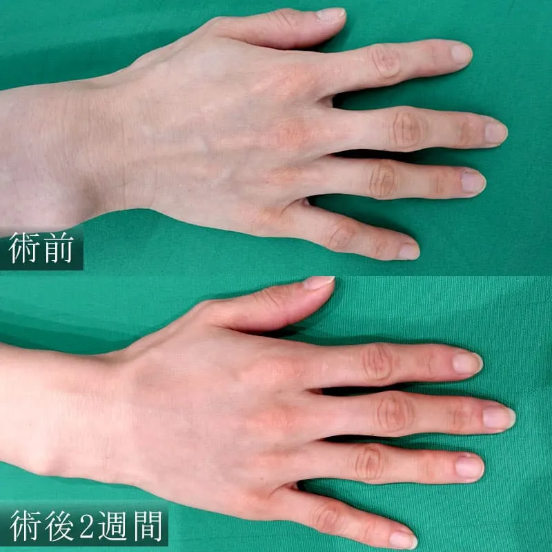 バイオスカルプチャーの症例写真