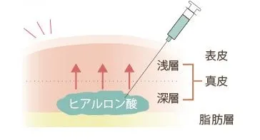 ヒアルロン酸注射の仕組み