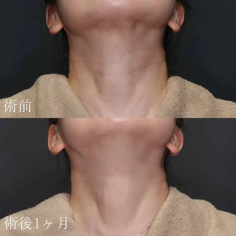 首のヒアルロン酸注射の症例写真①