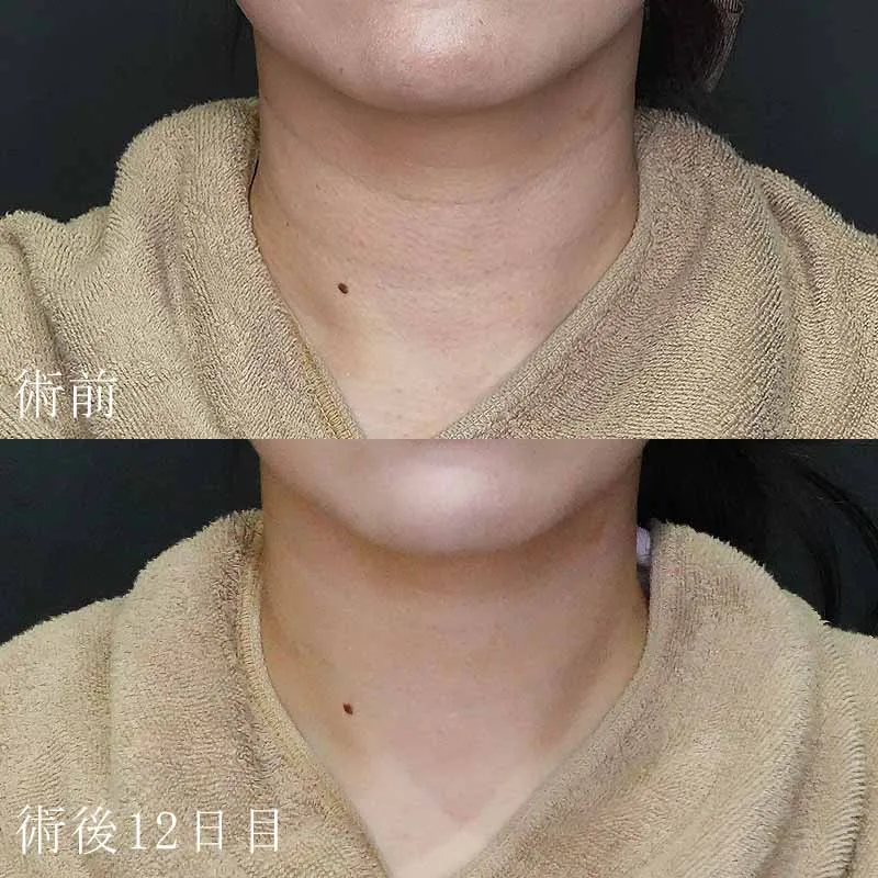 首のヒアルロン酸注射の症例写真②