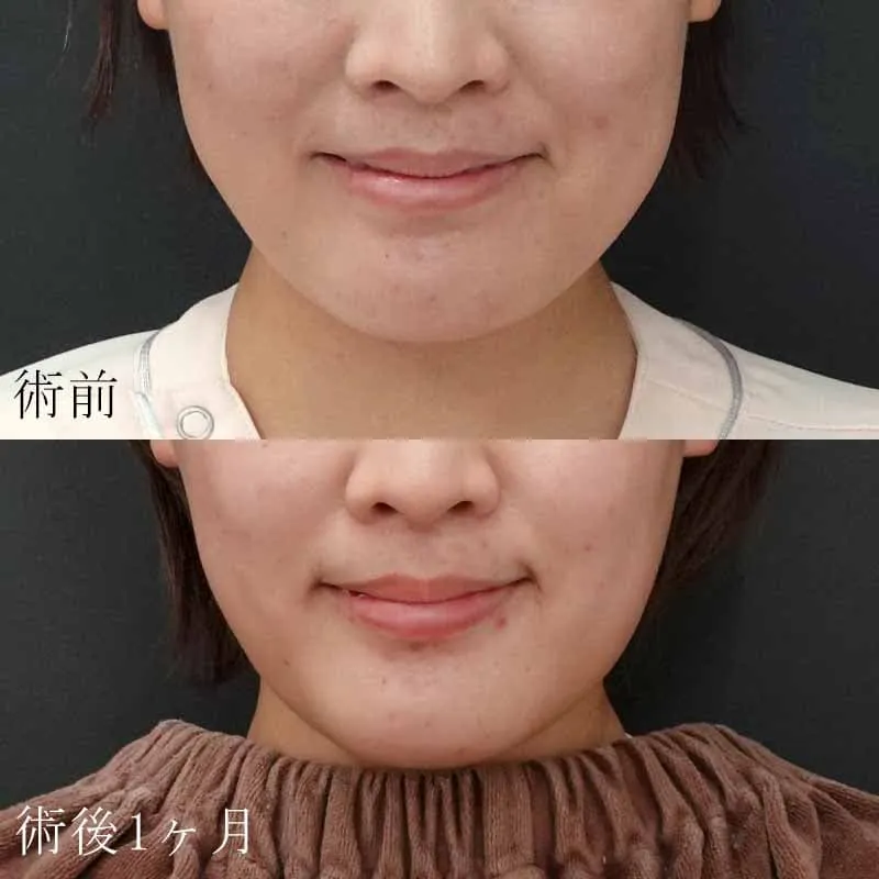 20代女性のボトックス注射の症例写真