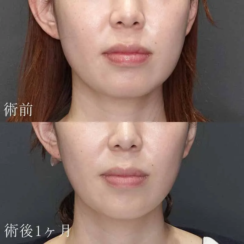 20代女性のボトックス注射の症例写真
