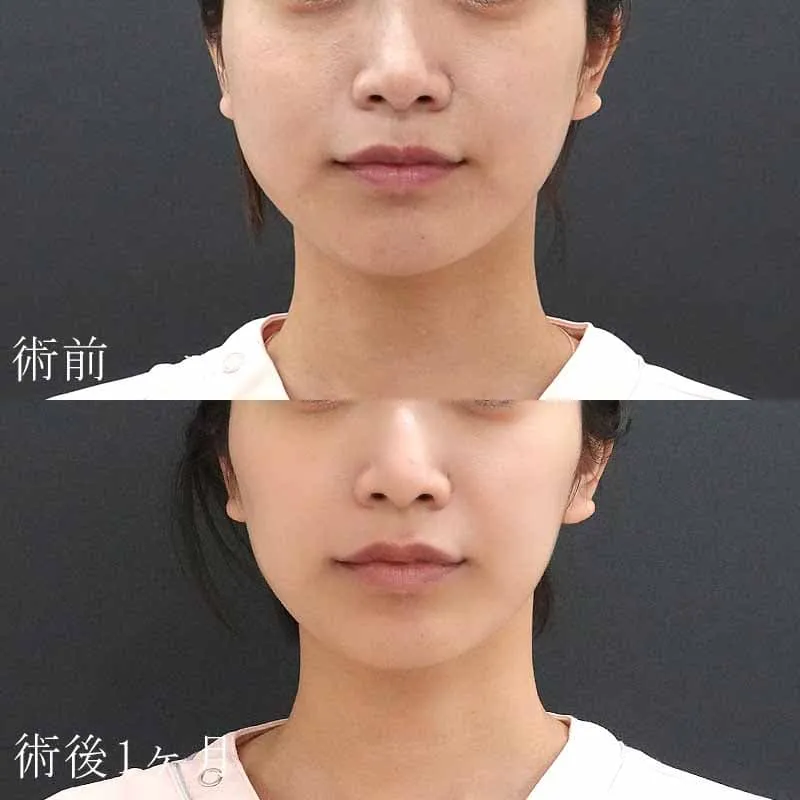 20代女性のボトックス注射の症例写真