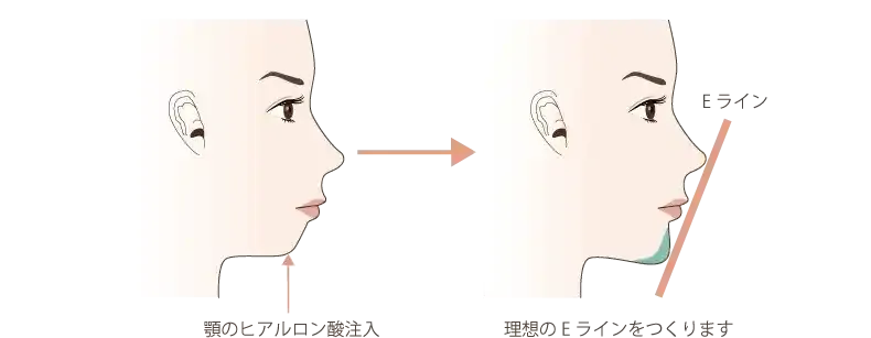 横顔のEラインを綺麗に整える