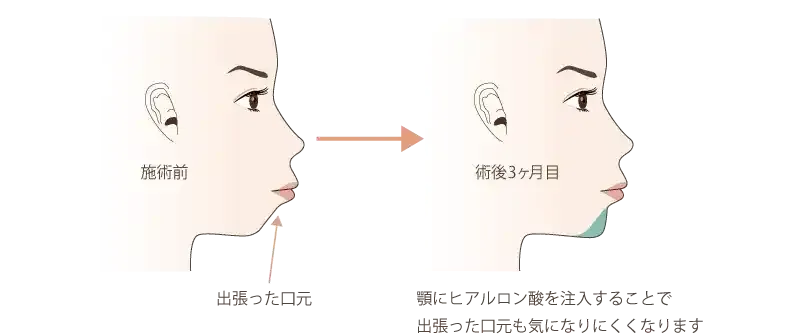 出っ張った印象の口元を緩和