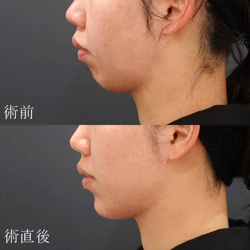口元の出っ張りを緩和した症例写真