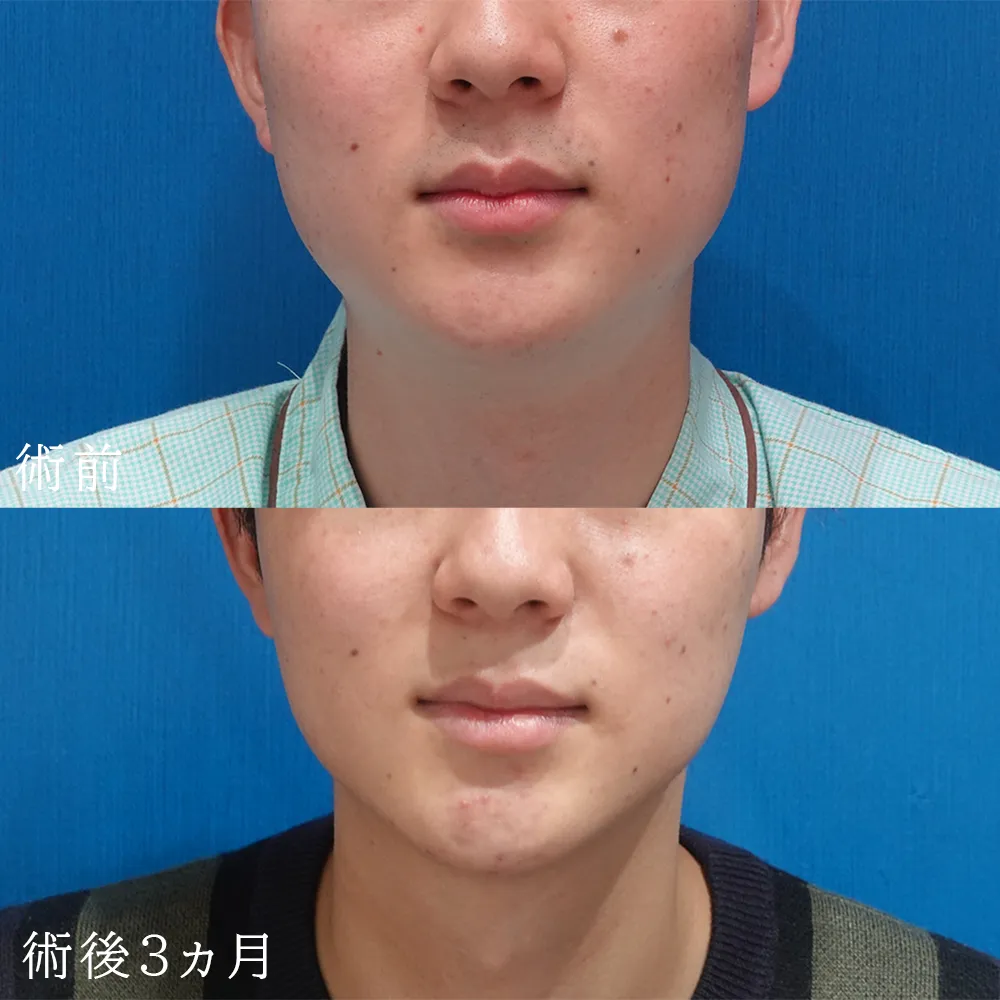 小顔(頬＋顎下)の脂肪吸引の施術症例写真-東京新宿院鈴木先生
