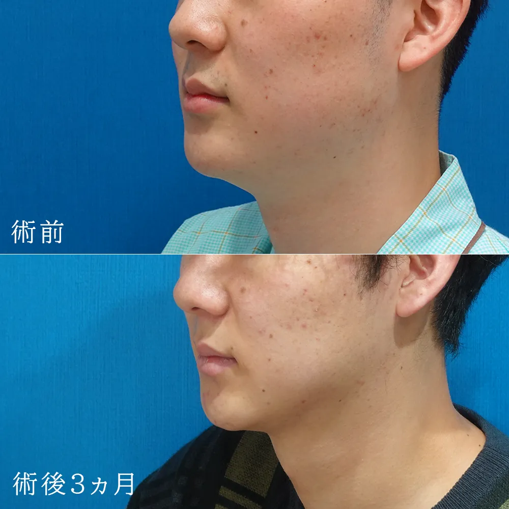 小顔（頬＋顎下）の脂肪吸引の施術症例写真-総院長