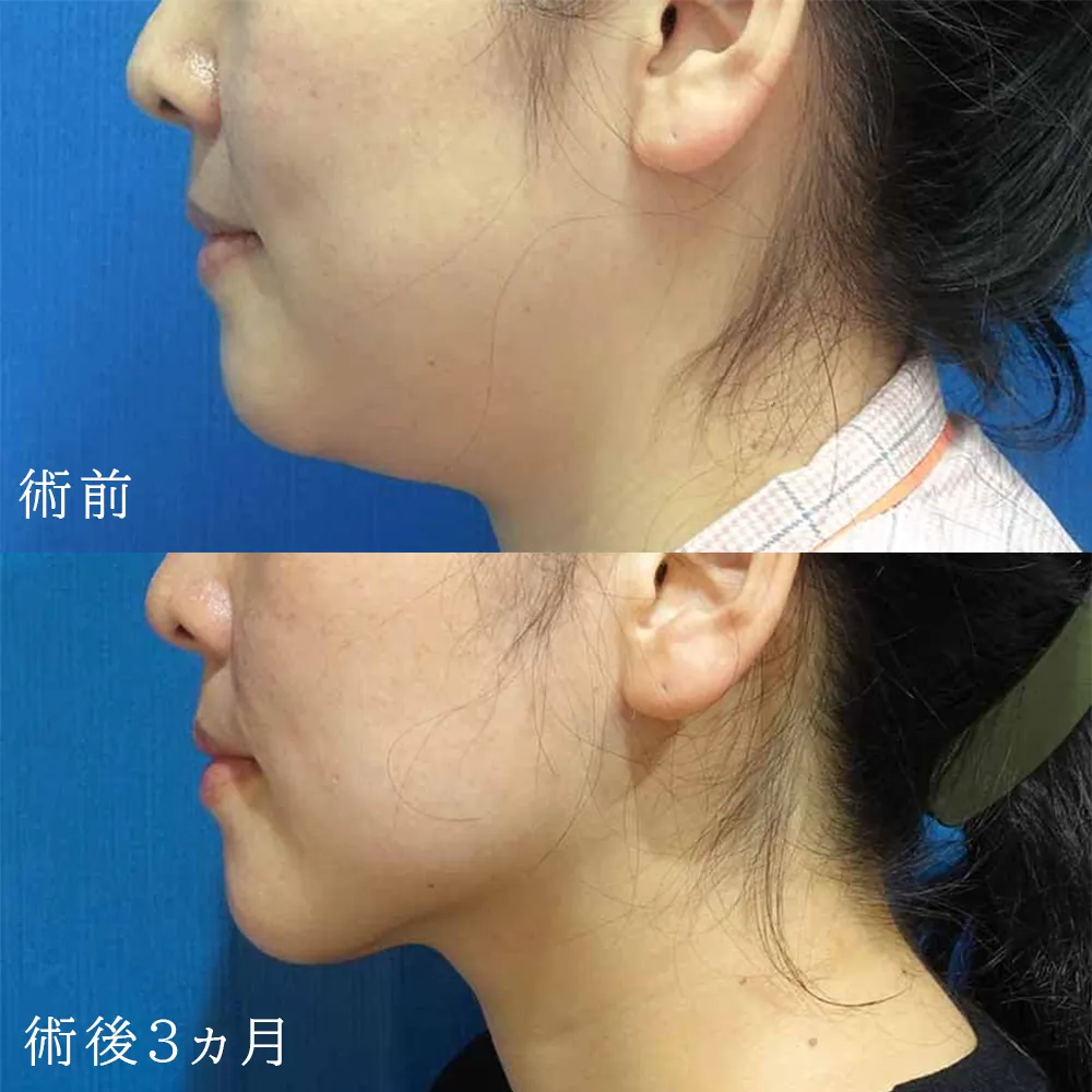 お顔の脂肪吸引と鼻・顎のプロテーゼの複合施術の症例