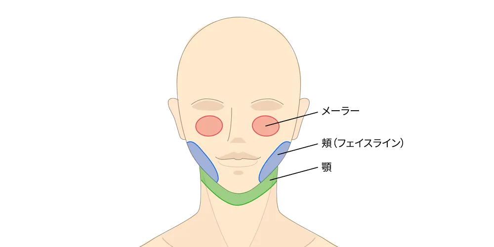 お顔の脂肪吸引の吸引部位