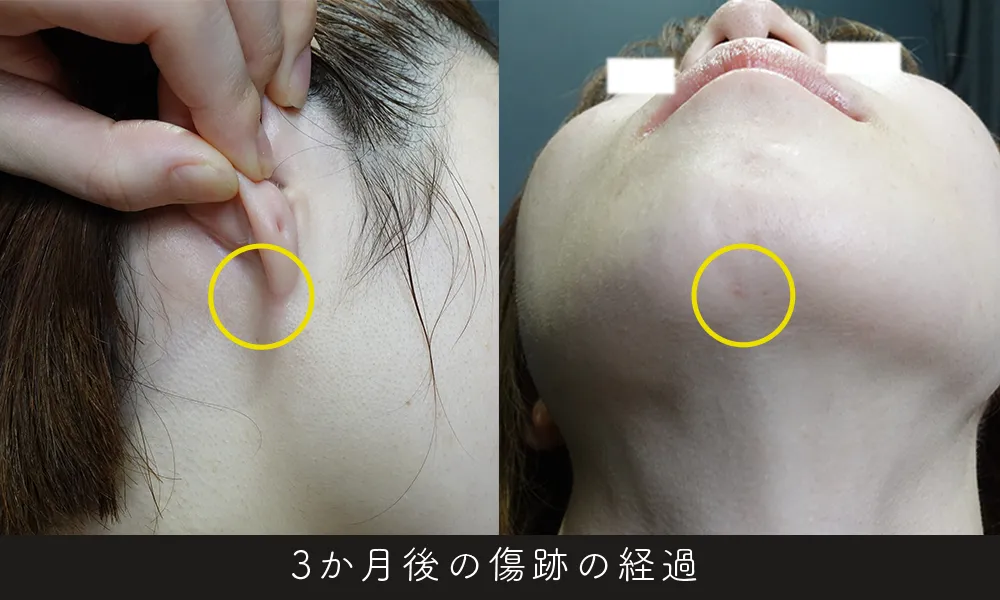 その3 目立たない傷跡