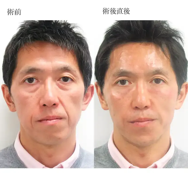 40代男性のヒアルロン酸リフトの症例写真