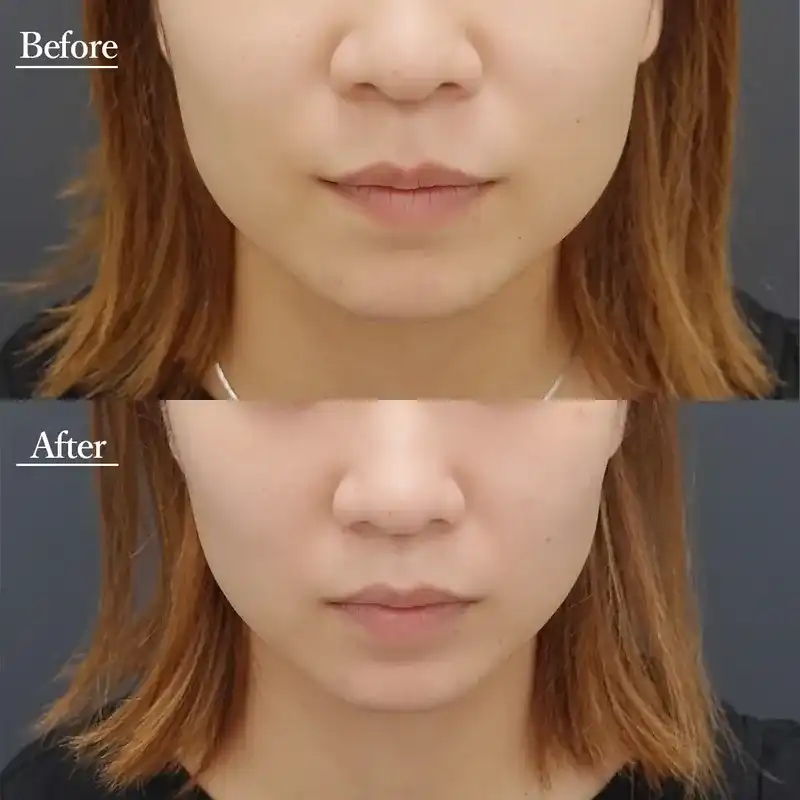 医療用ハイフ(HIFU)の症例写真