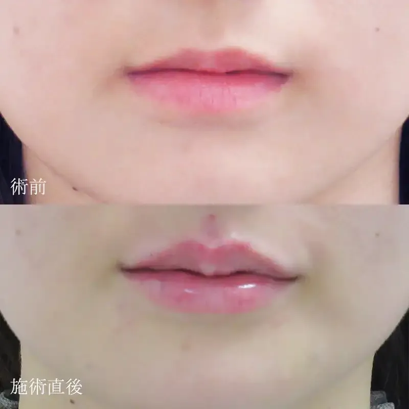 唇のヒアルロン酸注射の症例写真