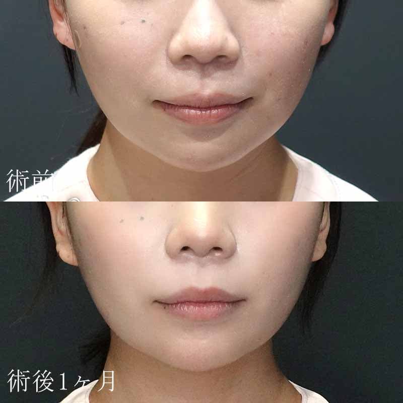 口角ボトックス注射の症例写真