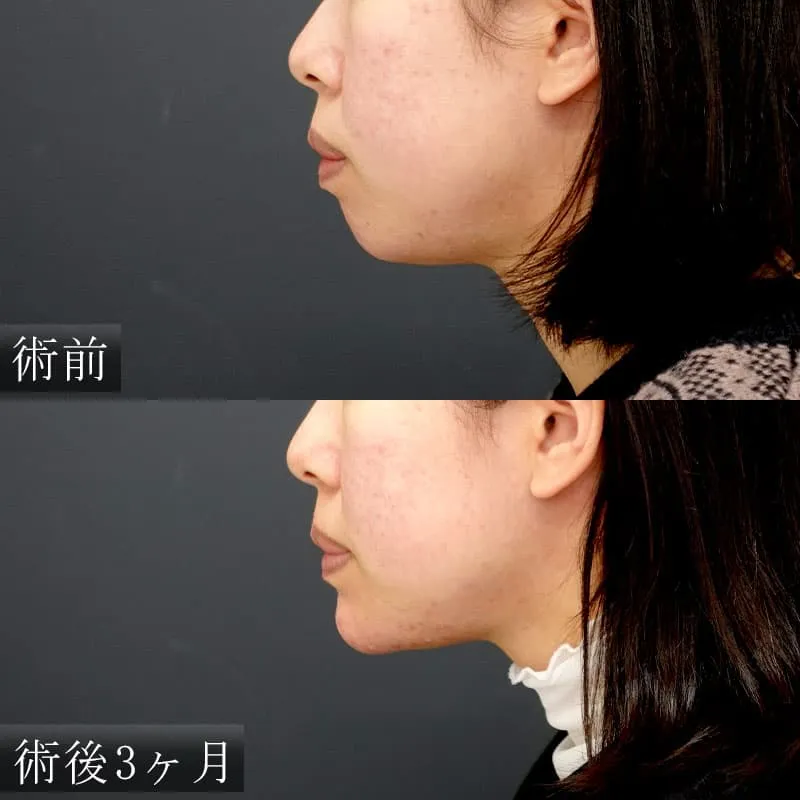 あごプロテーゼの症例写真