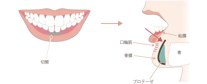 あごプロテーゼの施術方法